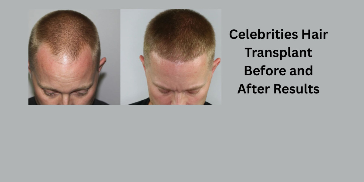 Celebrities Hair Transplant Before and After Results