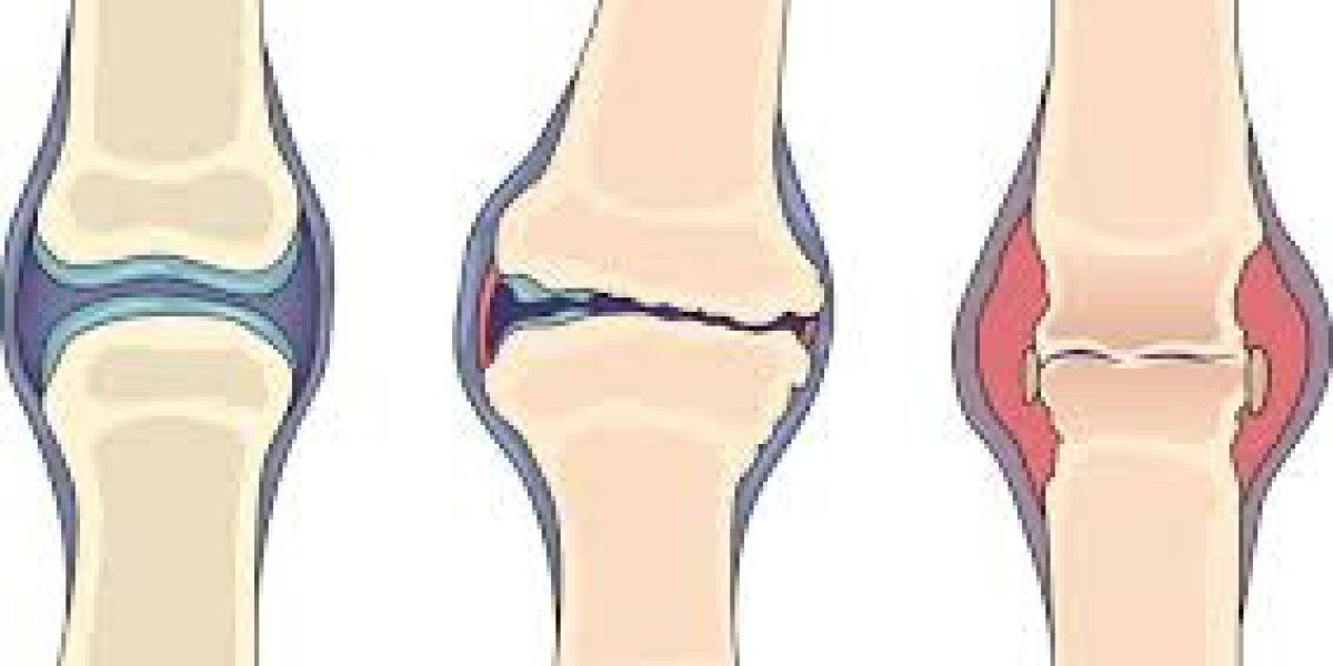 Osteoarthritis vs. Rheumatoid Arthritis: Understanding the Differences to Better Manage Joint Pain"