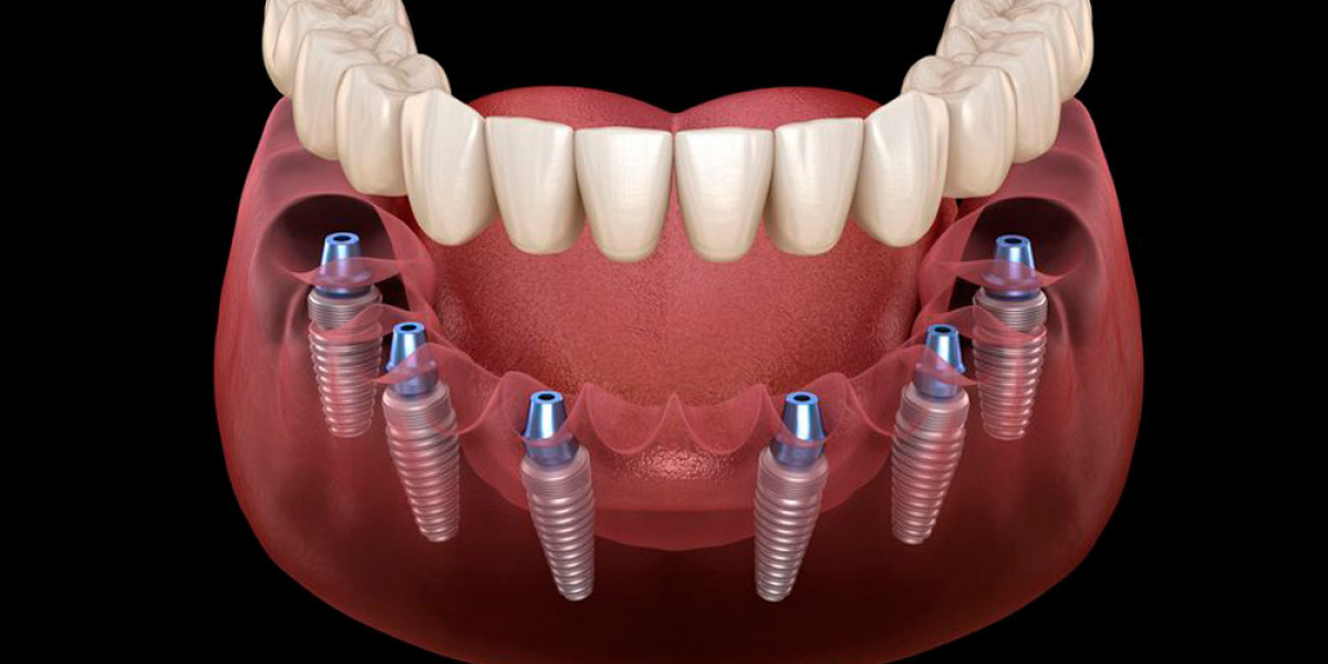 Sonrisa Segura y Estable: Ventajas de los implantes dentales 4 en 6