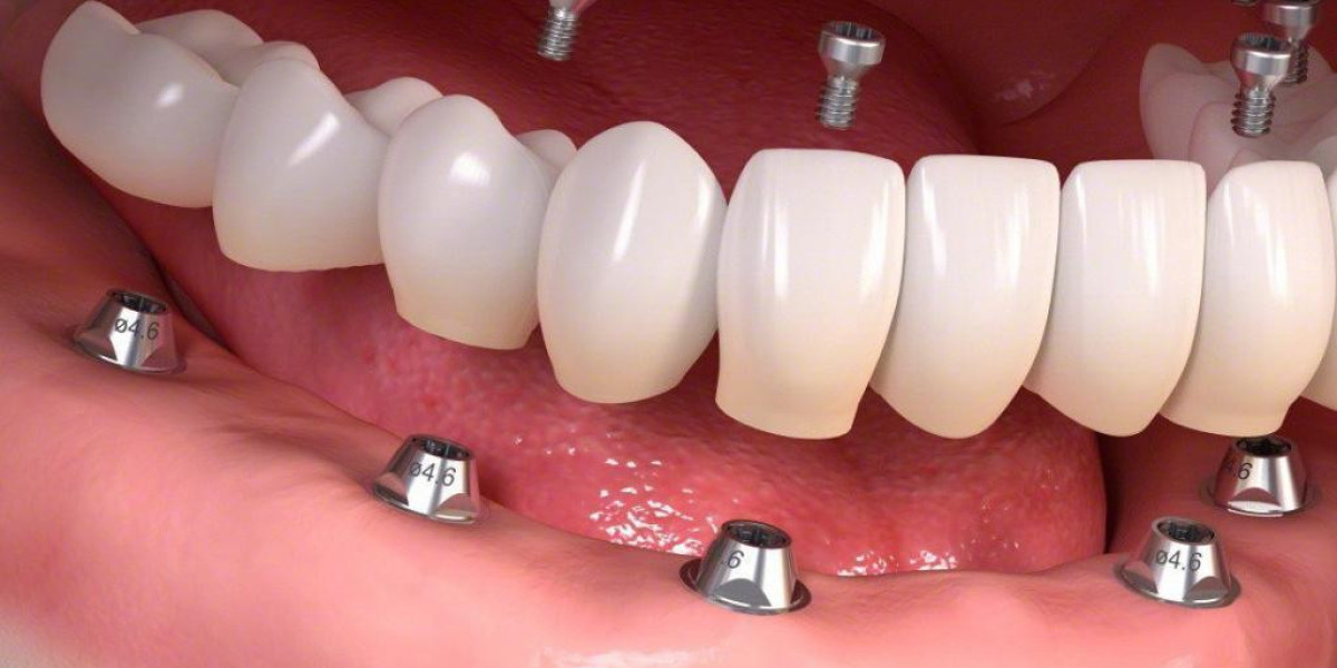 Solución avanzada para tu sonrisa: implantes dentales 4 en 6