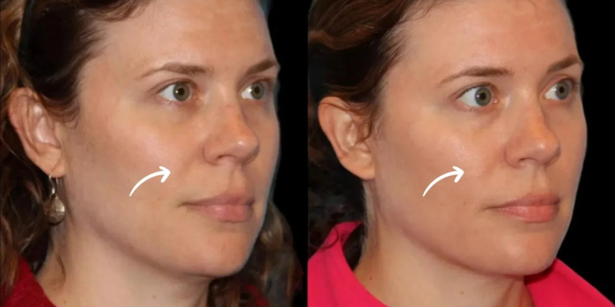 Introduction to the Best Doctors in Dubai Specializing in Sculptra Fillers