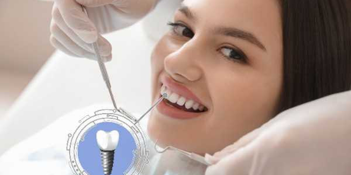 Long-Term Benefits of Implant Care in Chorley