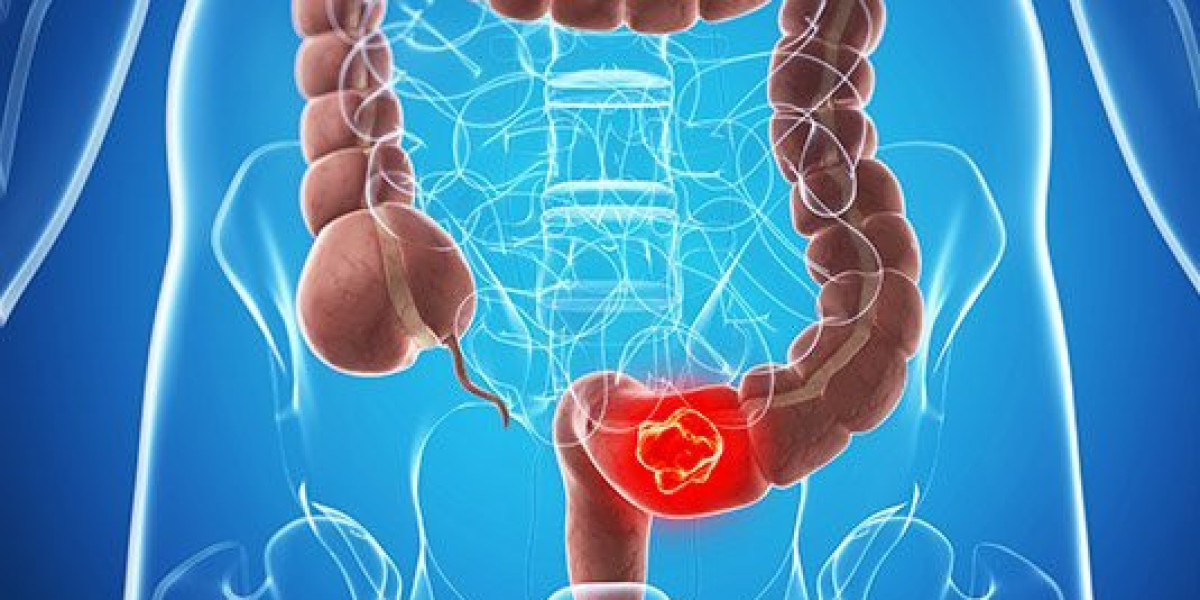 Colon Cancer Treatment in India: A Comprehensive Guide for Patients and Families