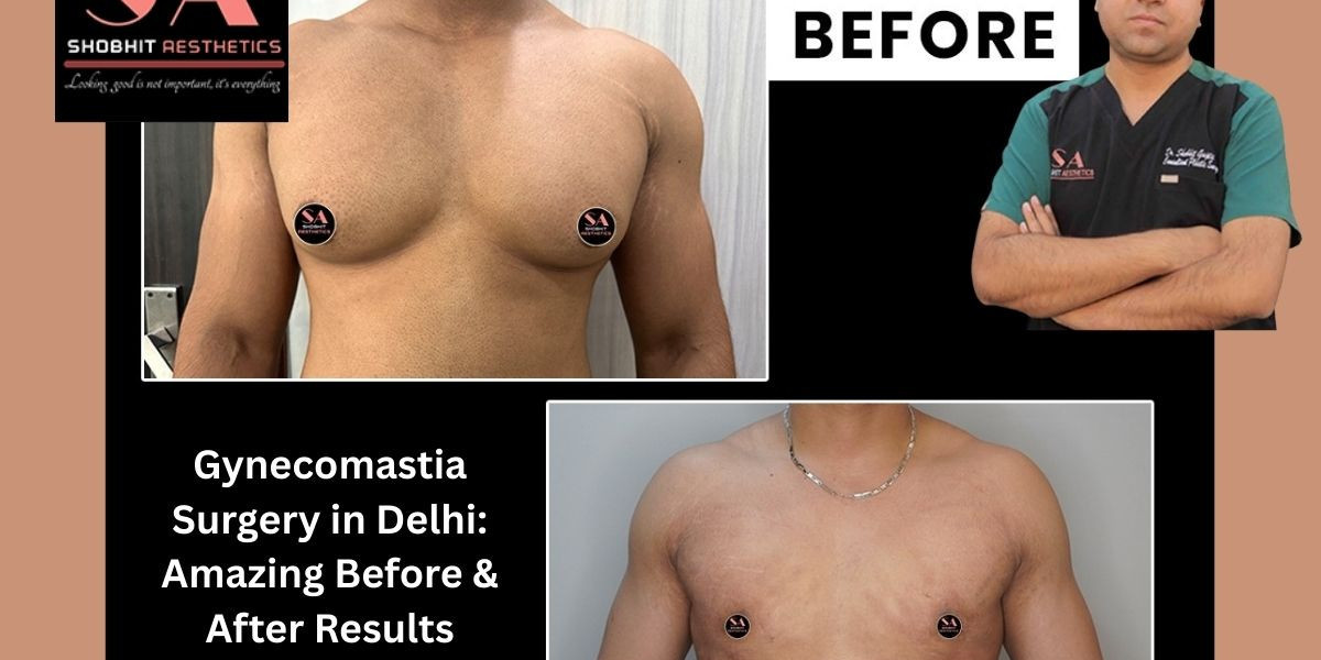 Gynecomastia Surgery in Delhi: Amazing Before & After Results