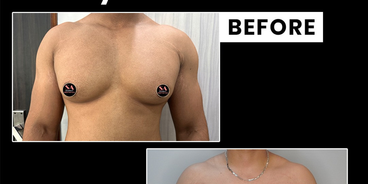 How Much Does Gynecomastia Surgery Cost in Delhi?