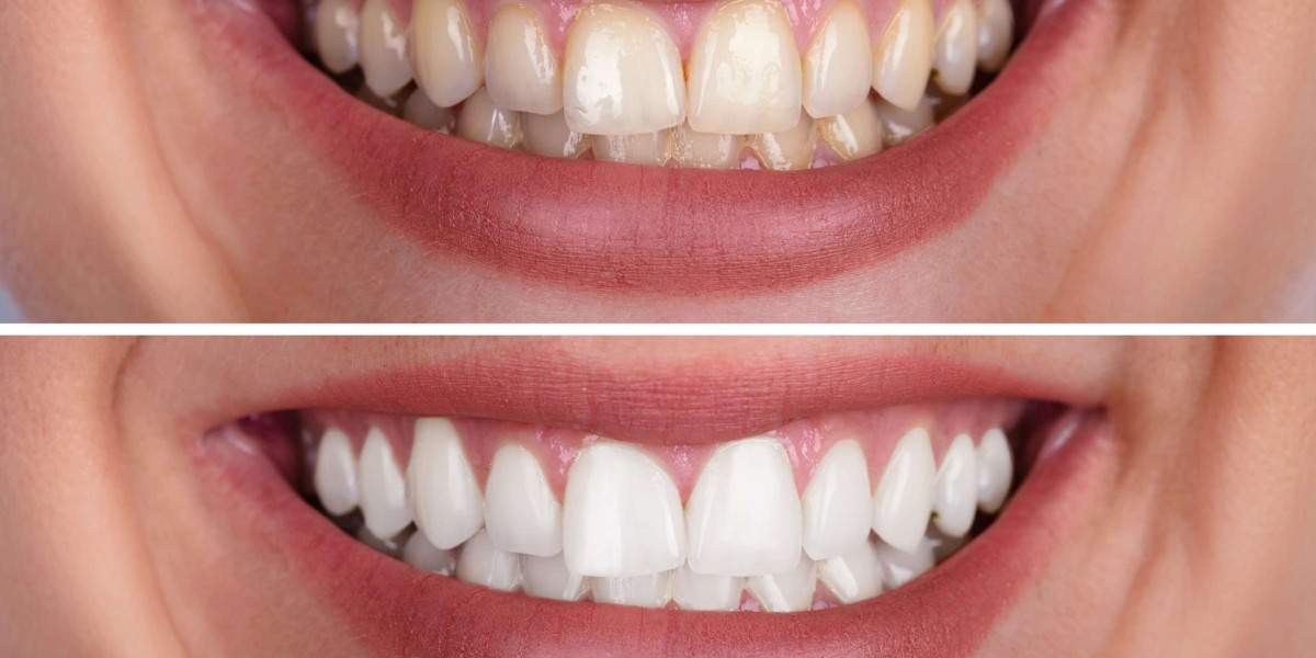 How Many Shades Whiter Can You Go with Teeth Whitening?