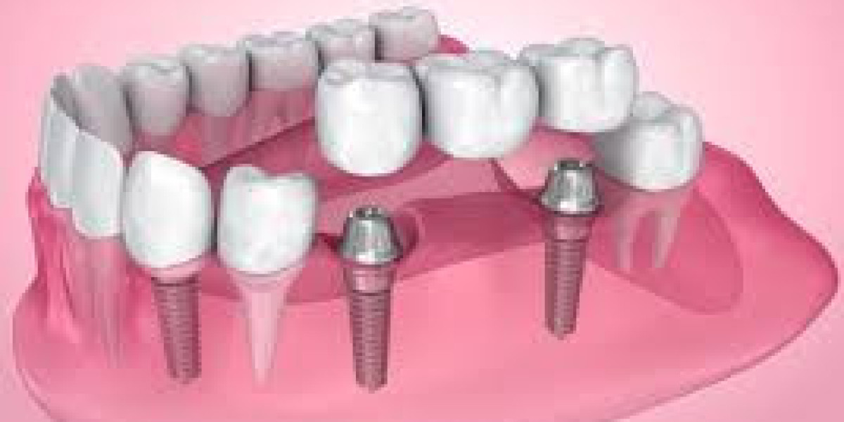 Why Permanent Teeth Replacement is the Best Investment in Glendale
