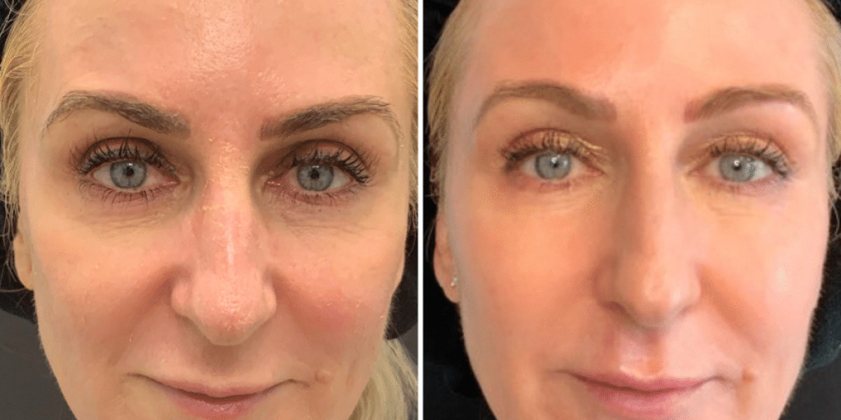 Radiesse vs Sculptra: Which Dermal Filler Is Right for You?