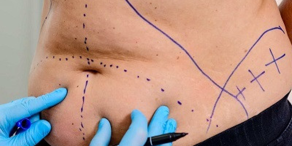 How to Choose the Best Liposuction Clinic in Riyadh