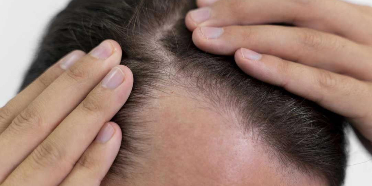 The Role of Platelets in PRP Hair Treatment Explained