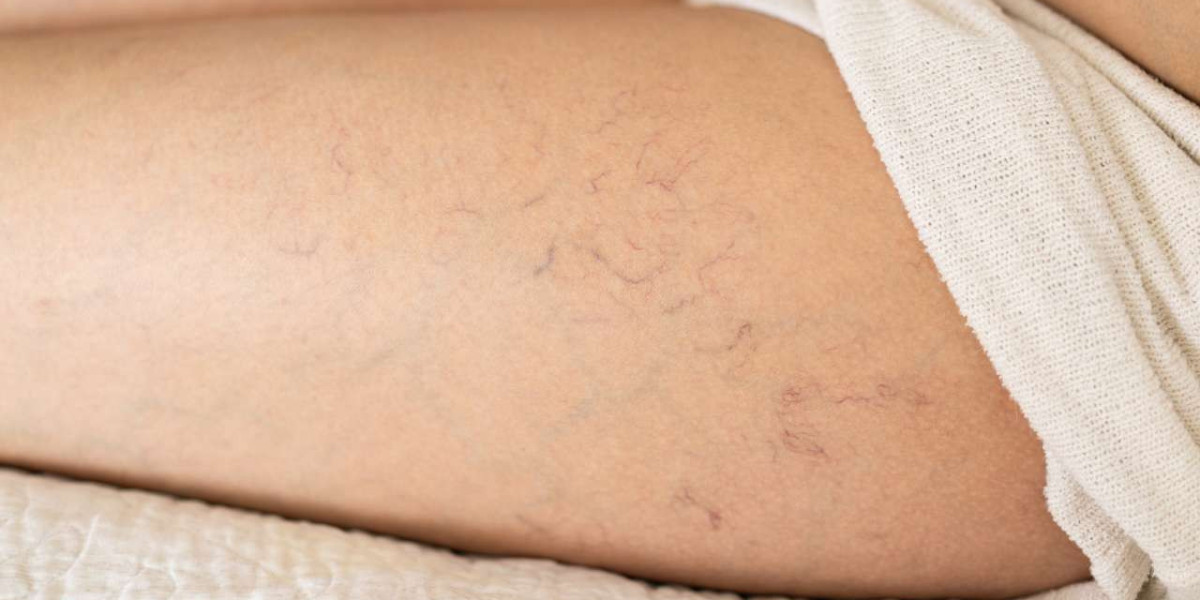 Does Laser Remove Spider Veins Better Than Injections?