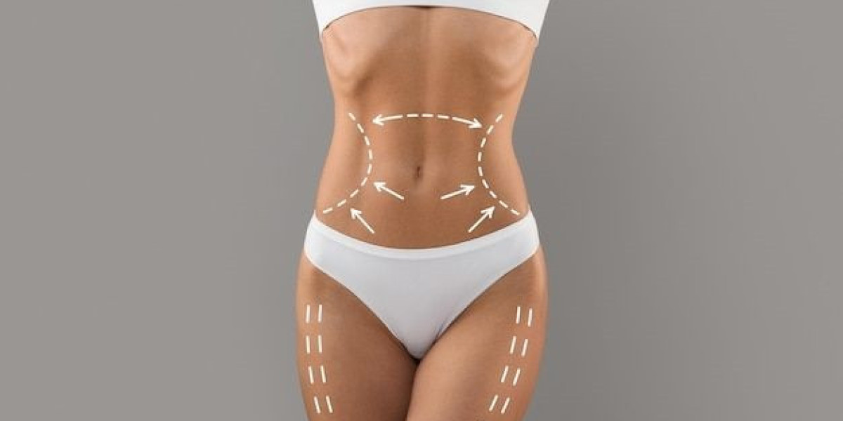 Achieve Toned Abs with BodyTite Liposuction: Before and After Insights