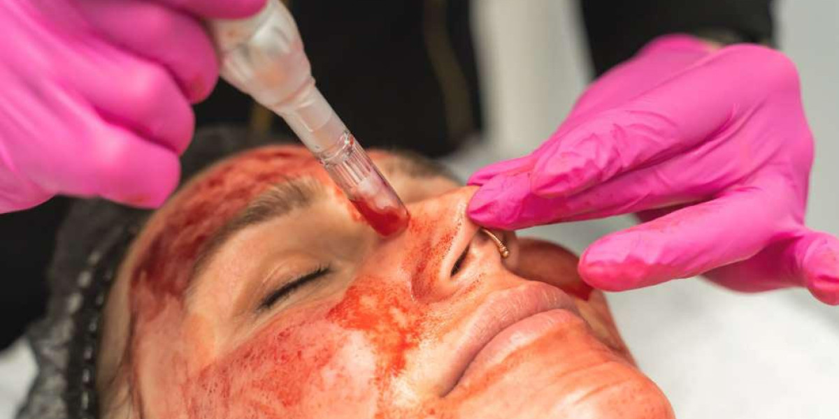 How Long Do Vampire Facial Results Last?
