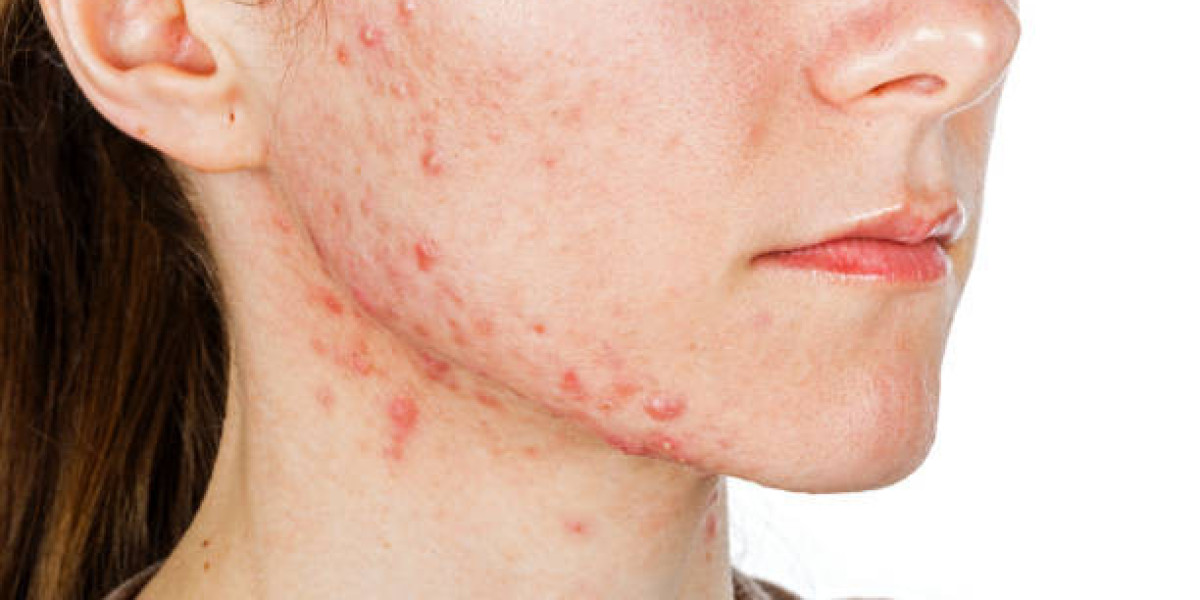 Pimples Treatment Guide For Clear Radiant Skin