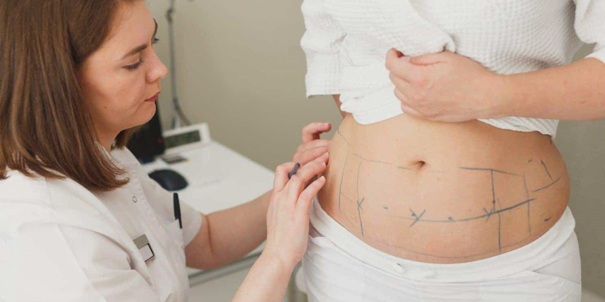 Laser Liposuction Process From Consultation to Final Results