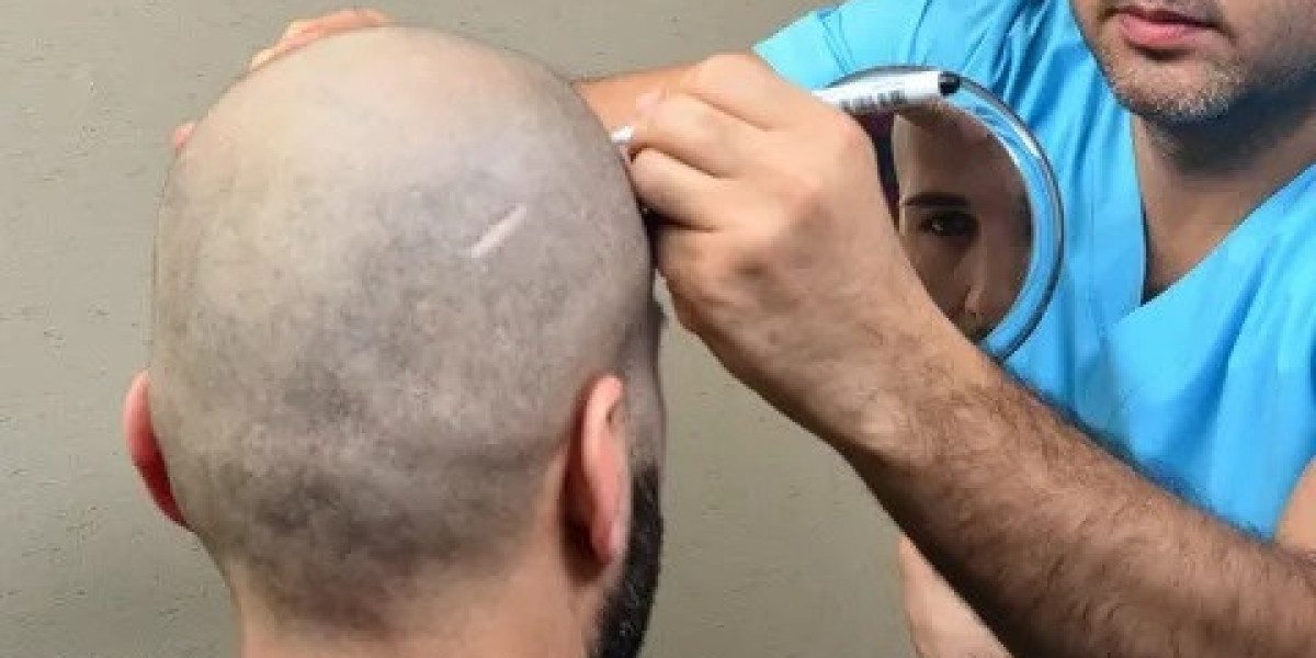 Hair Transplant in Riyadh: A Complete and Simple Guide to Hair Restoration