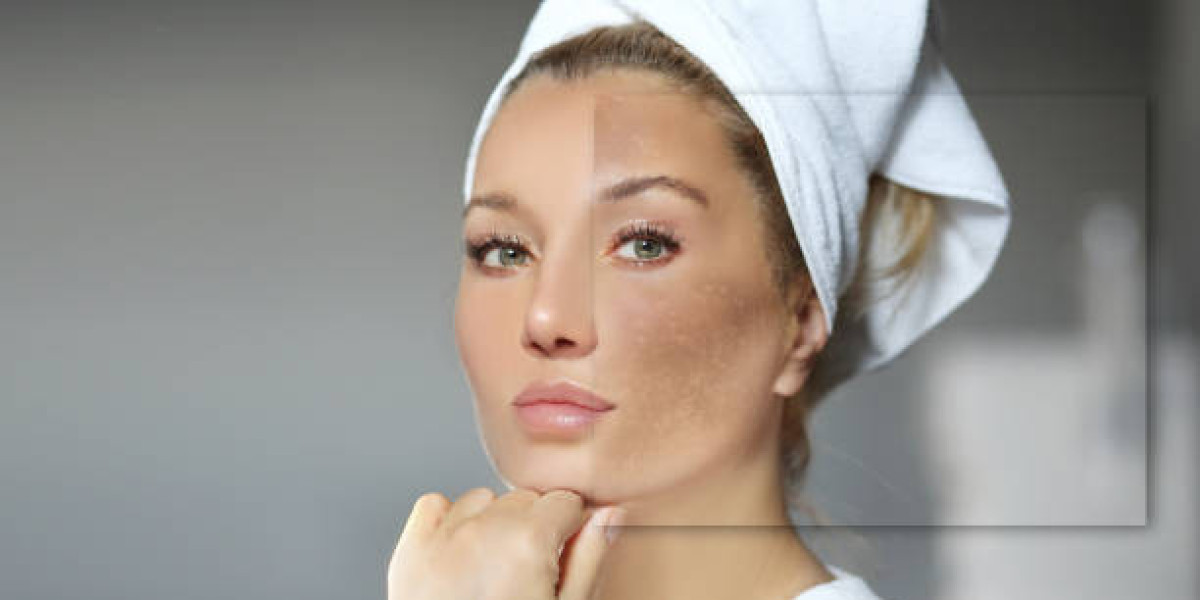 How Melasma Treatment Enhances Skin Clarity and Tone