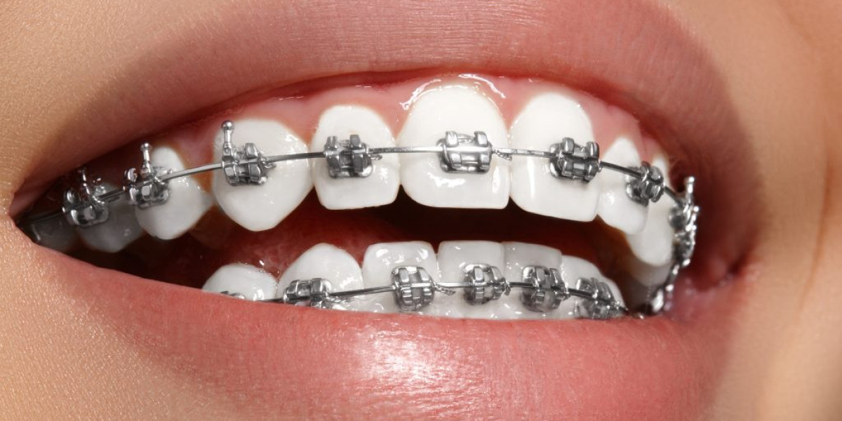 Straightening Teeth Made Simple: What Every Patient Should Know Before Starting Orthodontic Treatment in Juhu