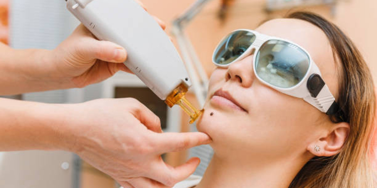 Mole Removal Techniques That Deliver Natural Results