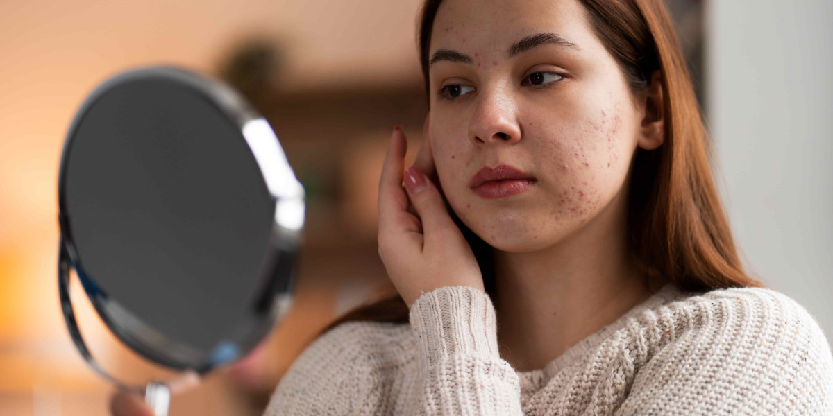 Hormonal Pigmentation: Why It’s So Common in Women