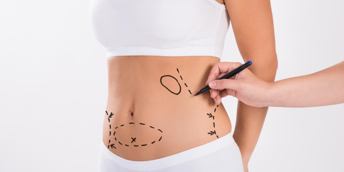 Liposuction in Dubai for Men and Women: Customized Fat Removal Solutions