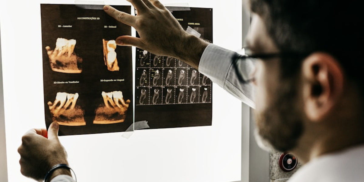 All-on-4 Romania: A Smart Solution for Full Smile Restoration