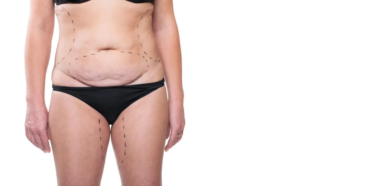 Tummy Tuck Scar Management Techniques