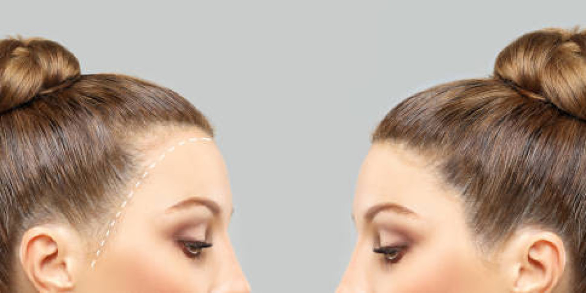 How Hair Restoration Contributes to Lifestyle Improvements