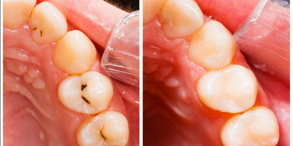 How Long Does It Take To Fill A Cavity at the Dentist