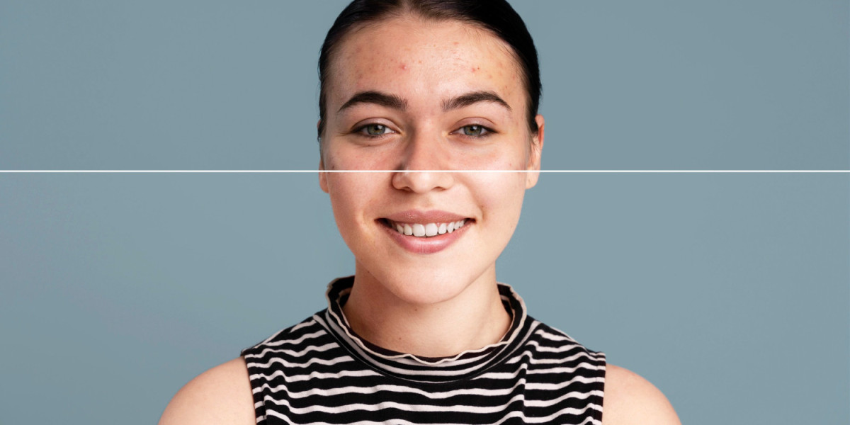 Clinic vs Home Treatment: Which Is Better for Acne Scars?
