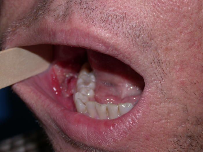 Oral Cancer Treatment Hyderabad | Dr. Kranthi Kumar