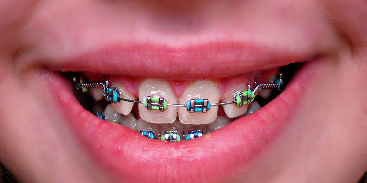 Teeth Braces Adjustment Guide: What Happens During Tightening