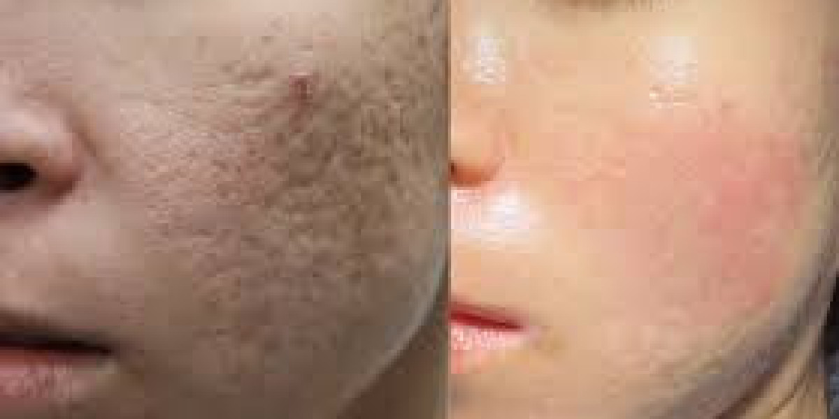 Best Treatment for Acne Scars: Effective Ways to Restore Smooth, Clear Skin