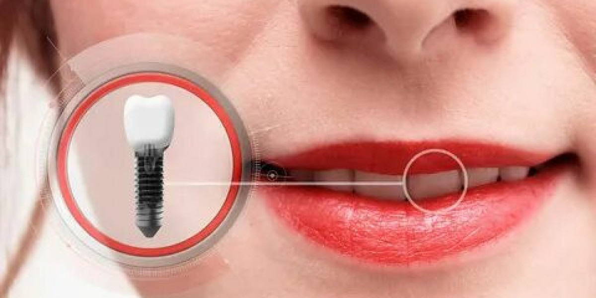 Same Day Dental Implants for Busy Patients: A Time-Saving Solution
