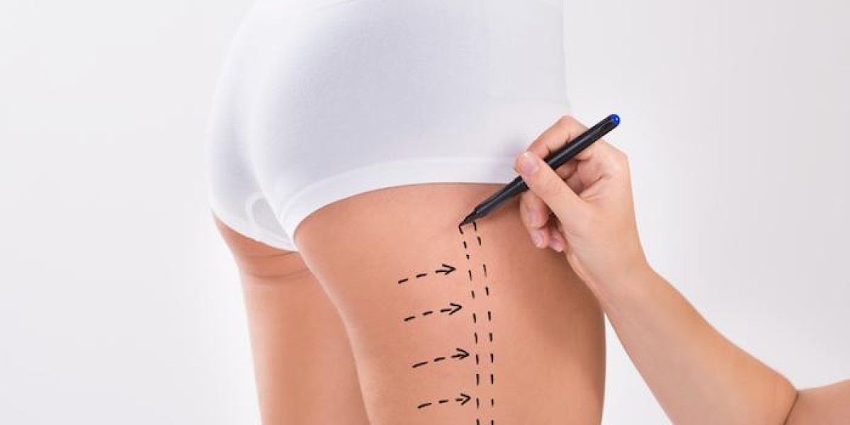 Discover the Benefits of Liposuction in Dubai for a Sculpted Look