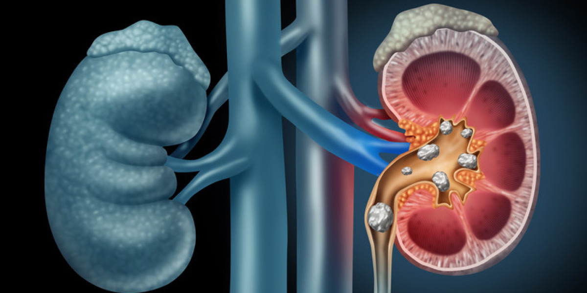 How Long Does It Take to Heal After Kidney Stone Removal?