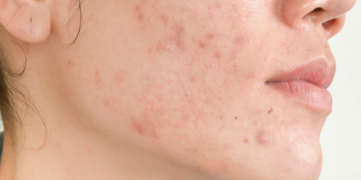 The Role of Soft Light Laser in Acne Treatment