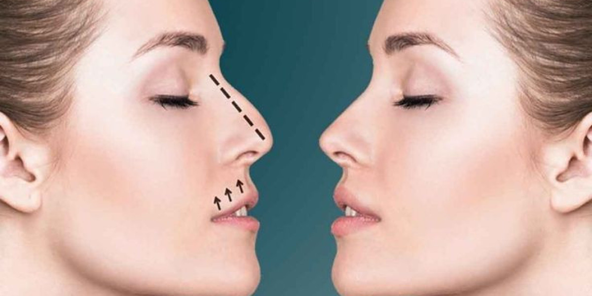 تكلفة تجميل الأنف في دبي: دليل شامل للأسعار والباقات