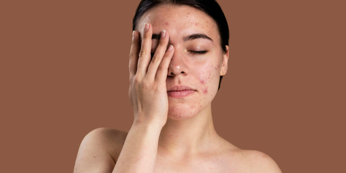 Why Acne Scar Treatment Costs Vary So Much
