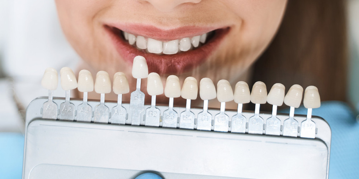 How to Pick the Right Dentist for Composite Veneers