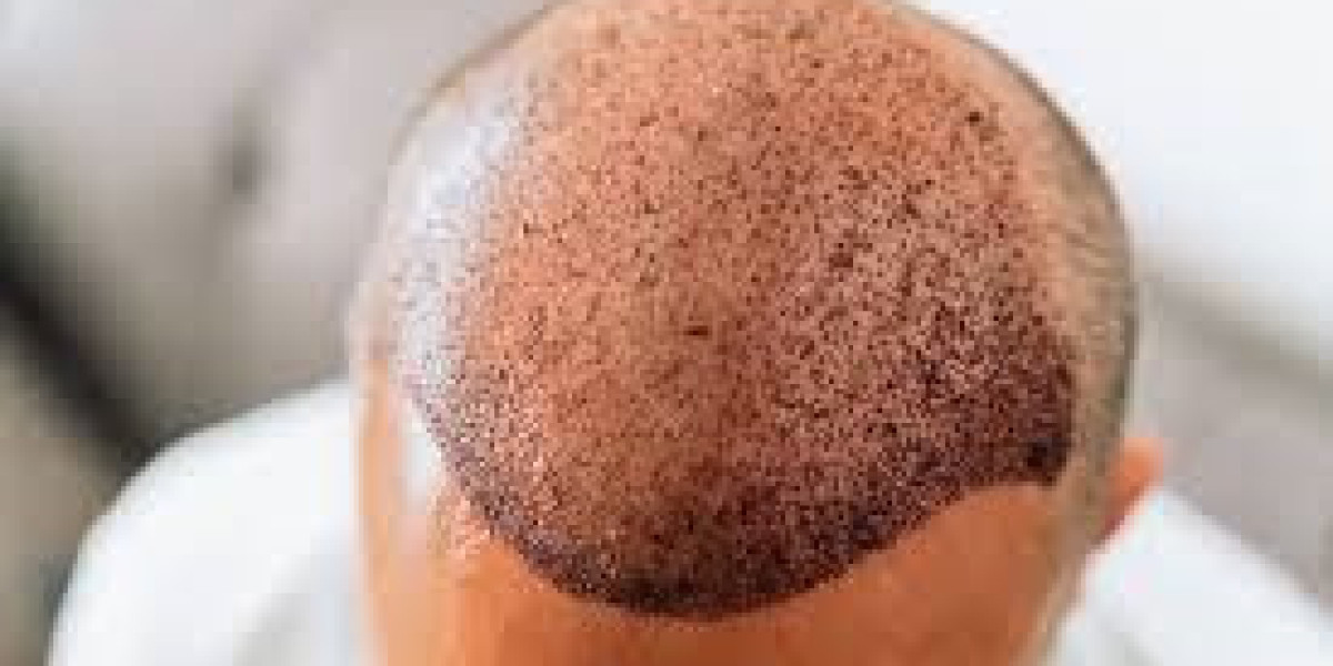 تجربة طبية بلمسة ملكية: زراعة الشعر في أرقى مراكز دبي