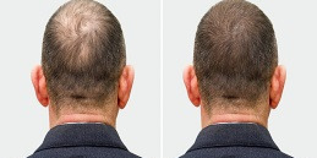 كيف تحصل على خصومات مميزة على تكلفة زراعة الشعر في دبي؟