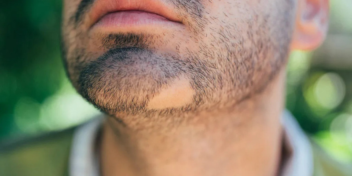 How Long Is Recovery After Beard Hair Transplant in Dubai