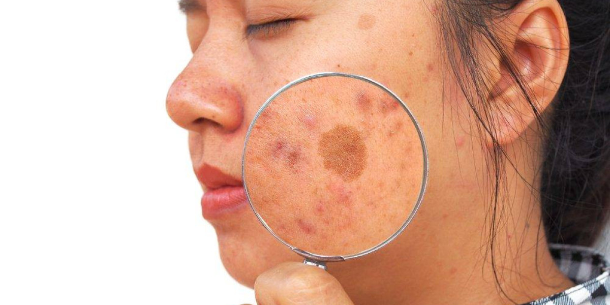 Melasma Treatment for Uneven Skin Texture
