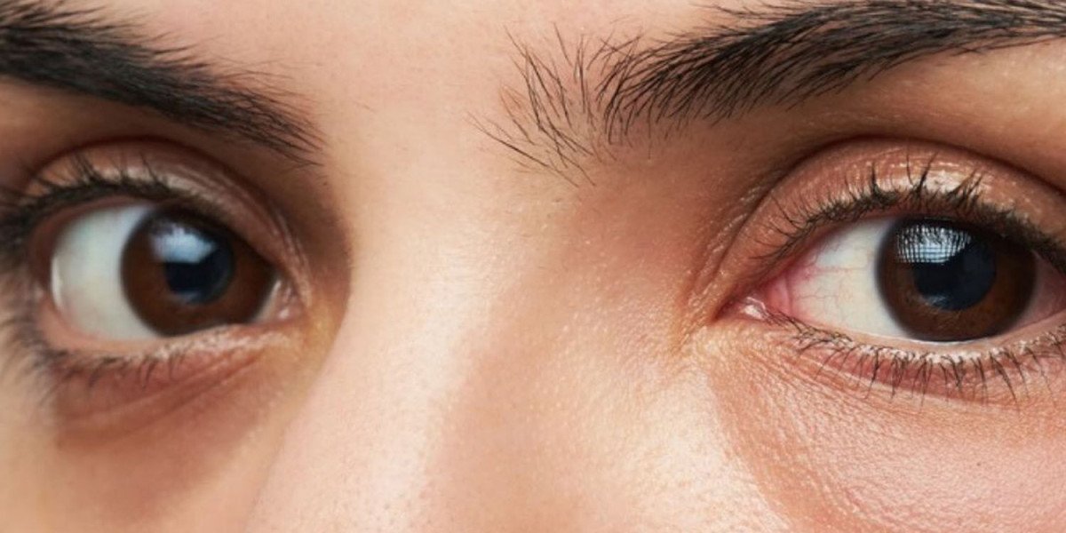 Eye Bag Removal for Sensitive Skin: Safe Options
