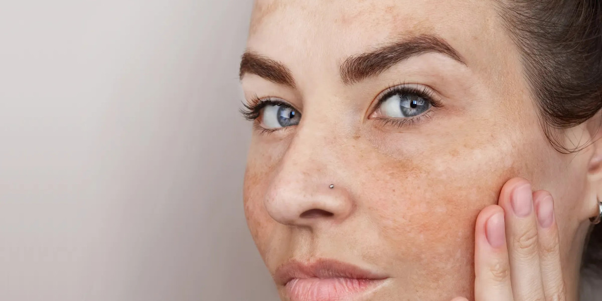 Why Is It Effective Pigmentation Treatment Dubai?