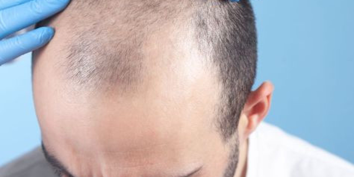 استعد ثقتك بنفسك: تعرف على تكلفة زراعة الشعر في دبي الآن