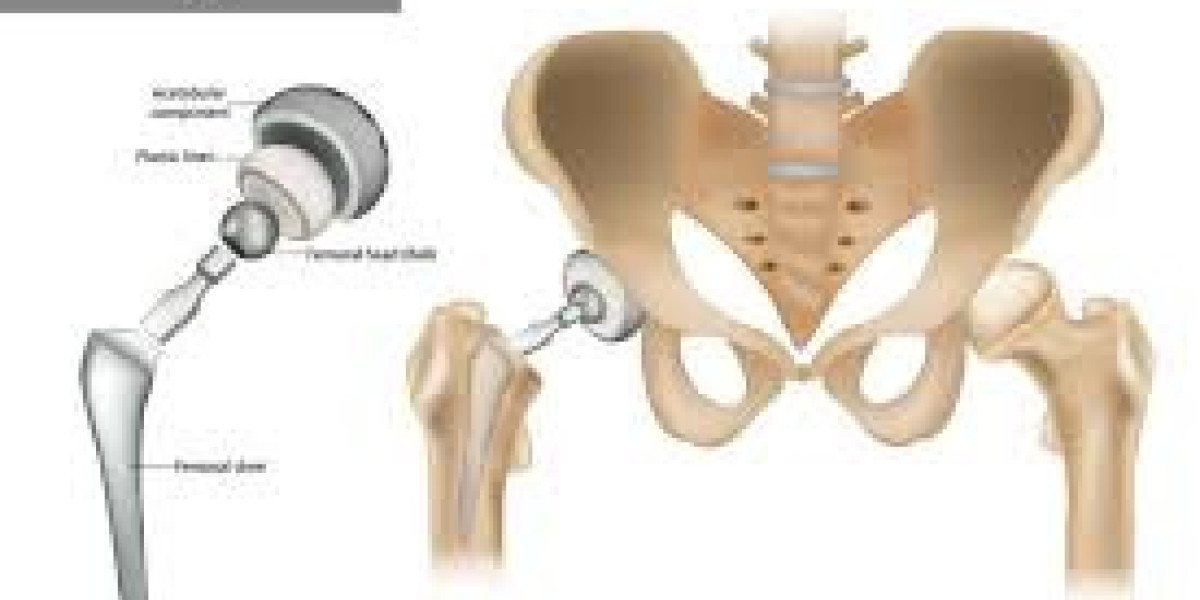 Cost of a Knee Replacement Privately Accurate Prices, What’s Included, and How to Compare Providers