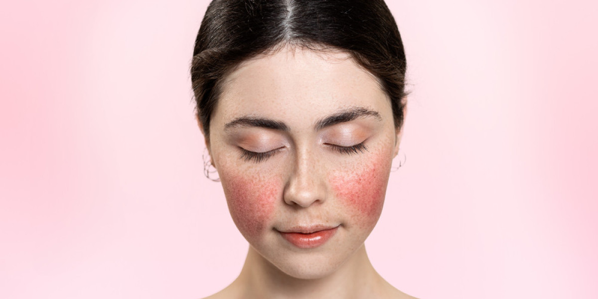 Common Ocular Rosacea Symptoms You Should Not Ignore