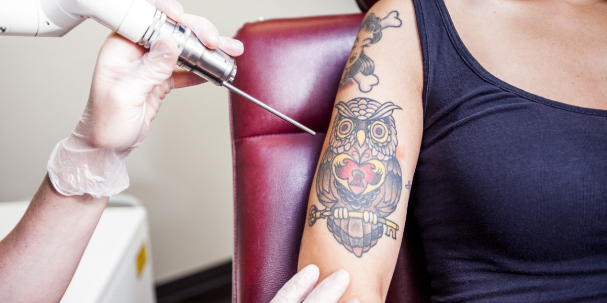 Tattoo Removal Process Explained in Simple Terms